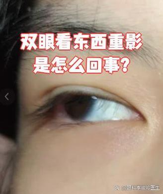 双眼重影单眼不重影如何治疗