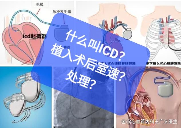 ICD术后最长活不过20年吗