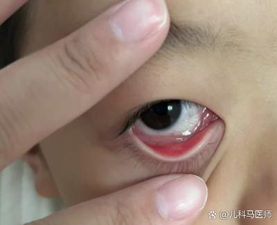 眼睛常流眼水怎么办 眼睛常流眼水怎么办