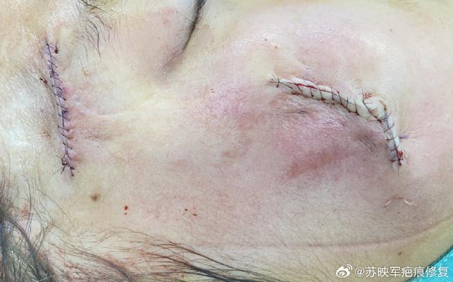疤痕印子怎样可以去除掉