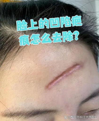 脸上的旧疤印怎么去除截图3