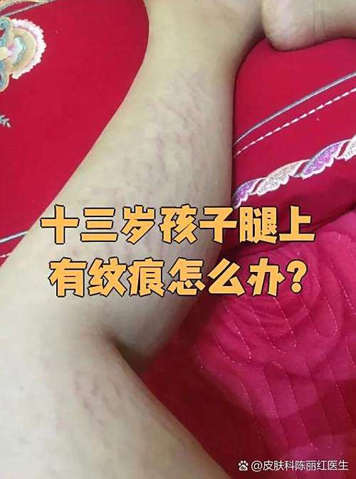 纹痕是什么意思
