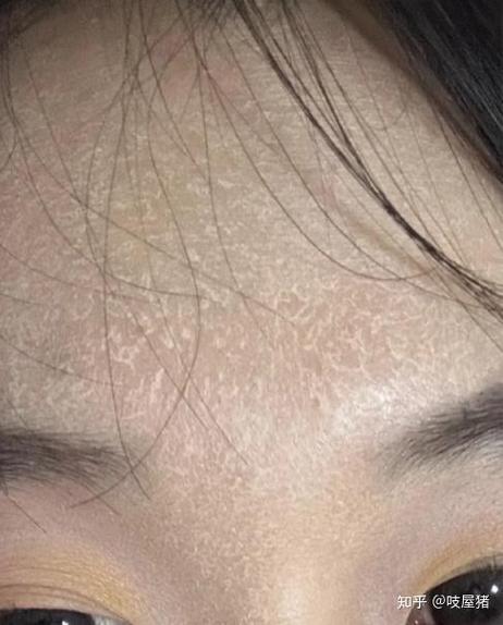 皮肤暴皮是怎么回事儿