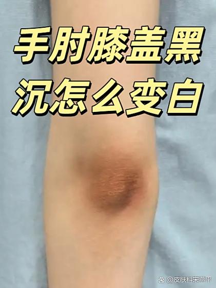 变黑了怎么快速变白