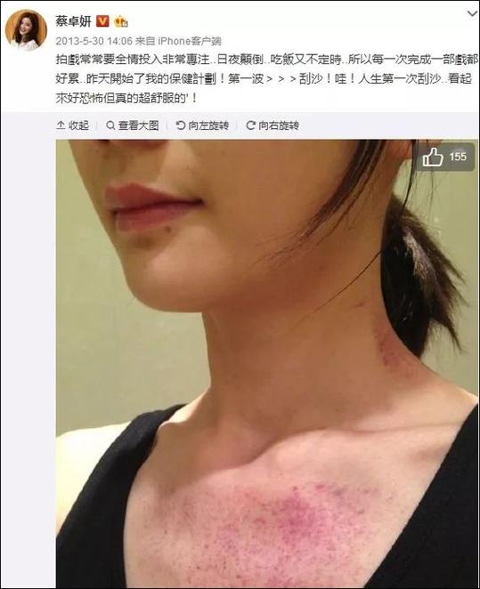 刮痧后洗澡会怎样截图3
