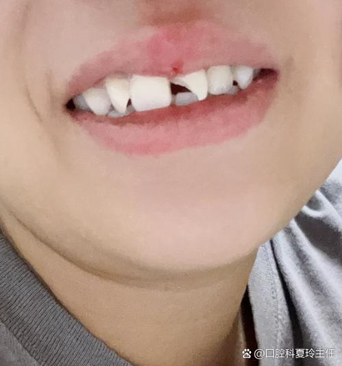 9岁小孩牙齿磕掉一小块截图1