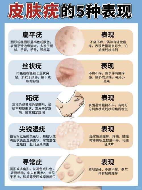 12种疣体图片和介绍
