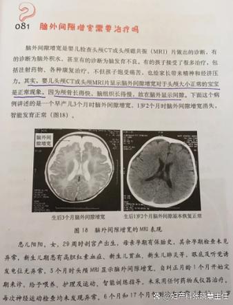 透明隔增宽是病吗