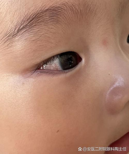 婴儿一边眼睛流眼水截图2