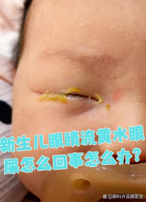 婴儿一边眼睛流眼水截图3