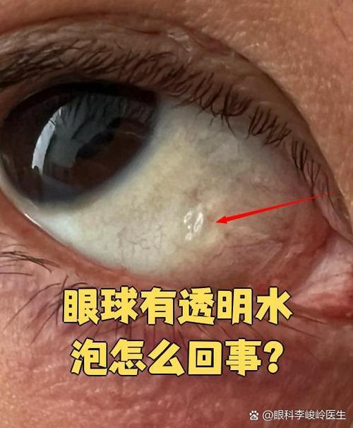 眼睛突然流眼睛水