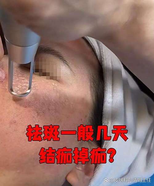 激光去斑多久掉痂