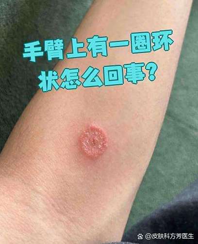 皮肤上出现白色圆圈是怎么回事