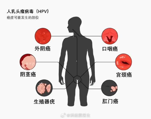 mds为什么不算大病