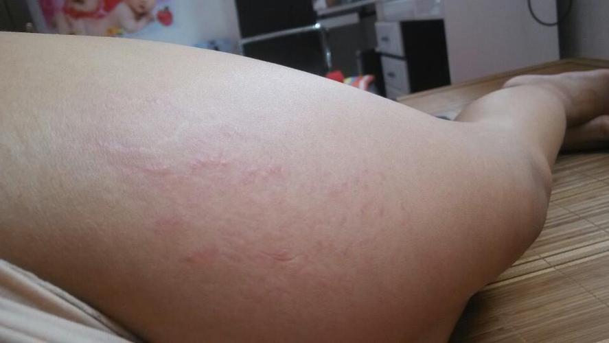 拍视频肚子妊娠纹怎么p掉