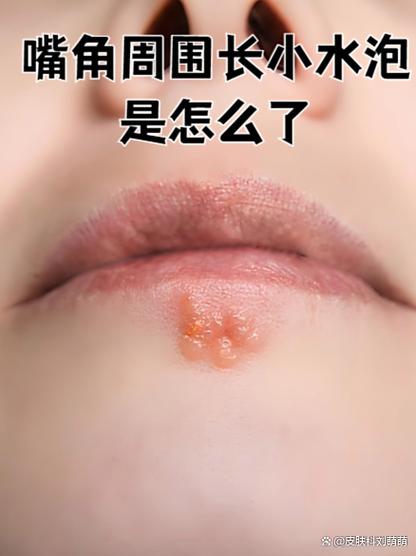 嘴起泡是怎么回事