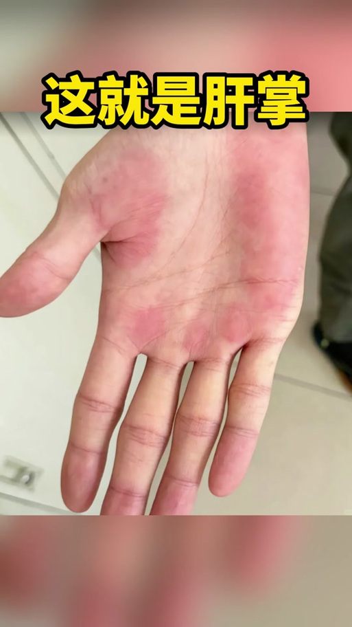 手掌发红是什么原因