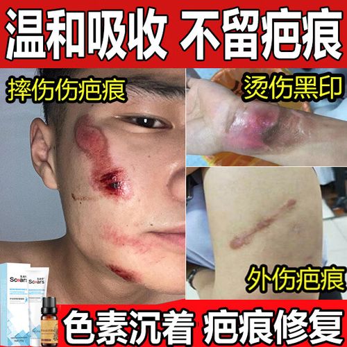 黑印疤痕怎么去除截图1