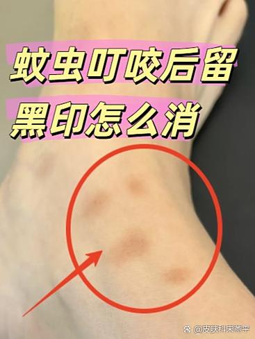 黑印疤痕怎么去除截图2