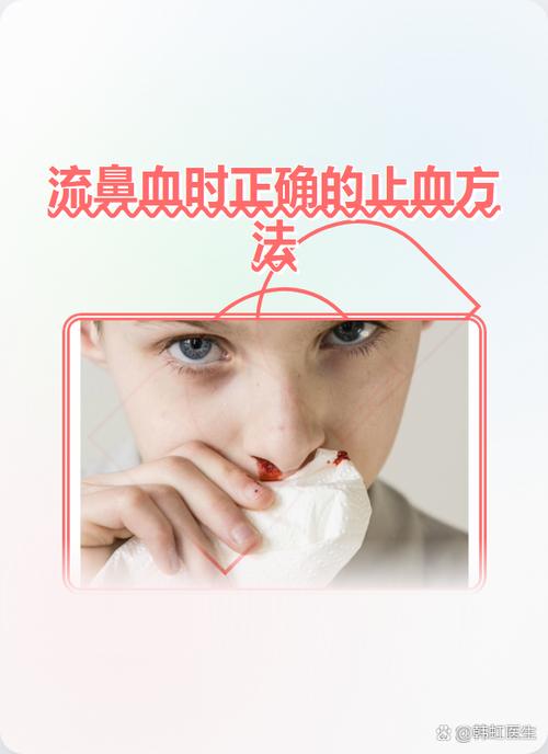 流鼻血怎么治疗方法最快最有效