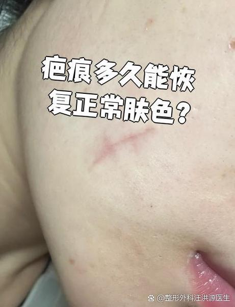 色素疤痕能恢复到正常肤色吗?