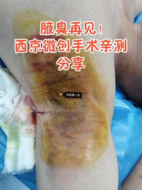 腋臭手术一般多少钱正规医院