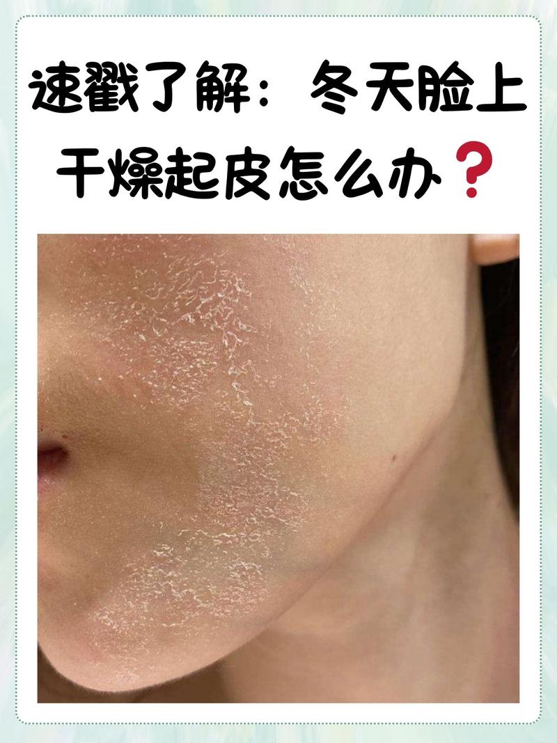 皮肤赖皮是怎么回事