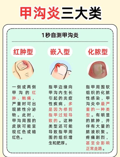 特严重甲沟炎视频