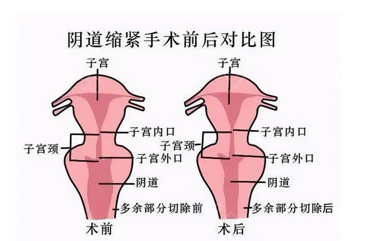 紧缩术后50天可以同房了吗