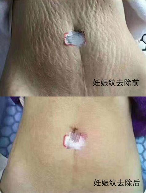 妊娠纹可以去除吗