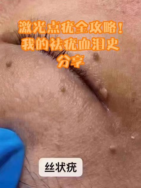 激光去疣花了8000报销多少