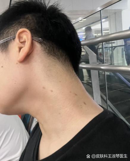 皮肤出现黑点是怎么回事