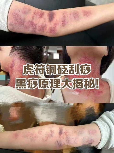 刮痧的痧多久能消啊
