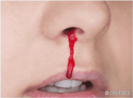 高血糖流鼻血怎么回事