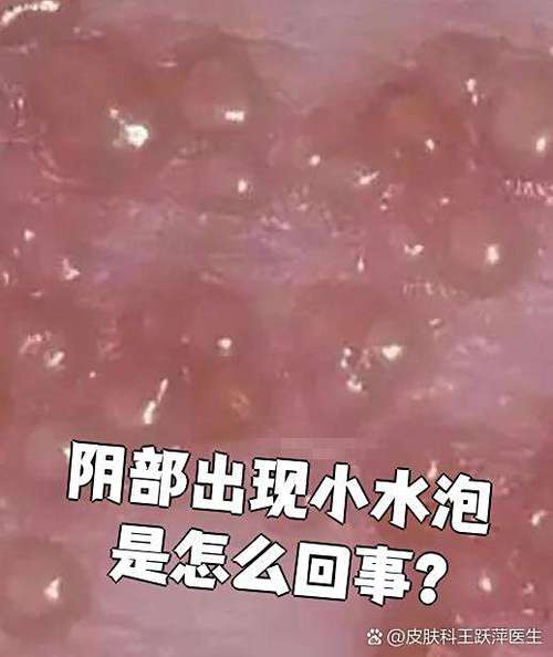 私处起水泡怎么回事