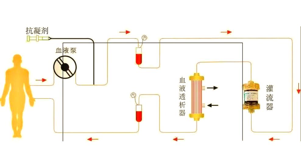 血液灌流是什么意思