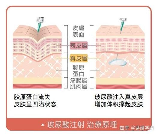 玻尿酸的原理