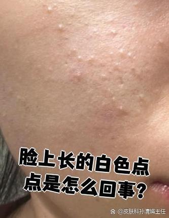 皮肤出现小白点是怎么回事截图3