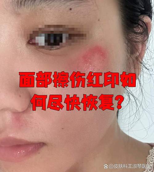 脸上痂皮掉了是红色的