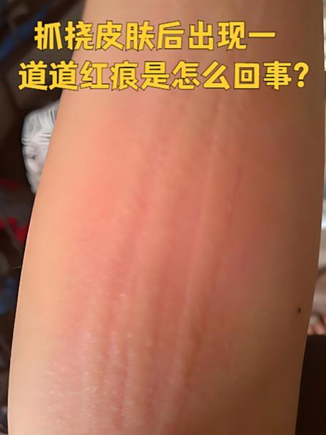 皮肤出现划痕是怎么回事