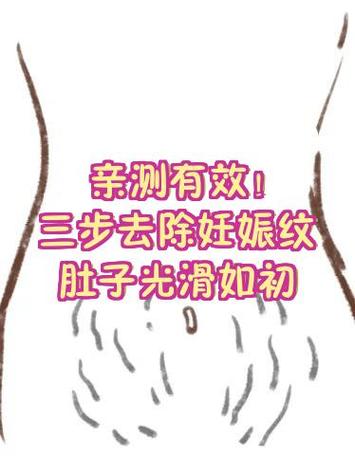 肚子上的妊娠纹怎么彻底去除