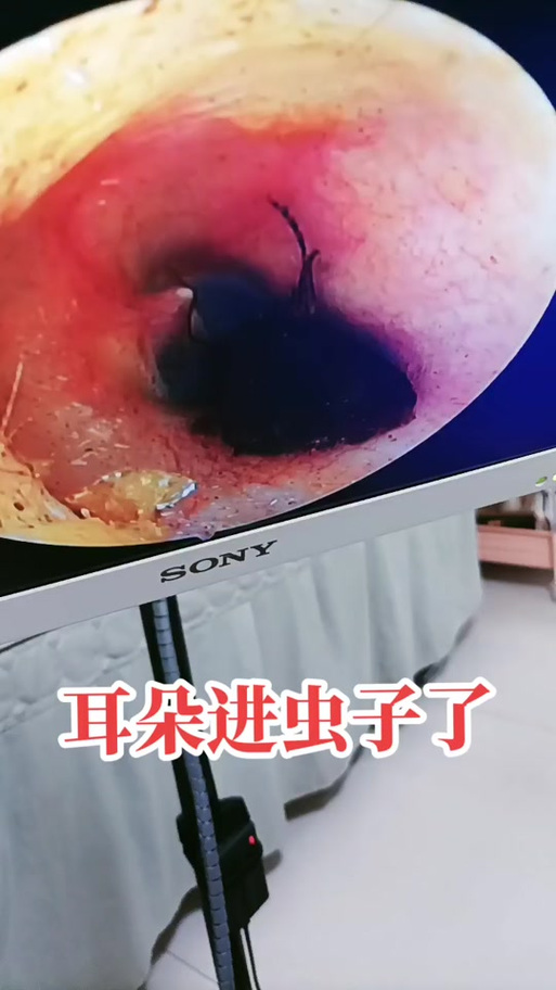 美女时被寄生虫钻入耳朵控制