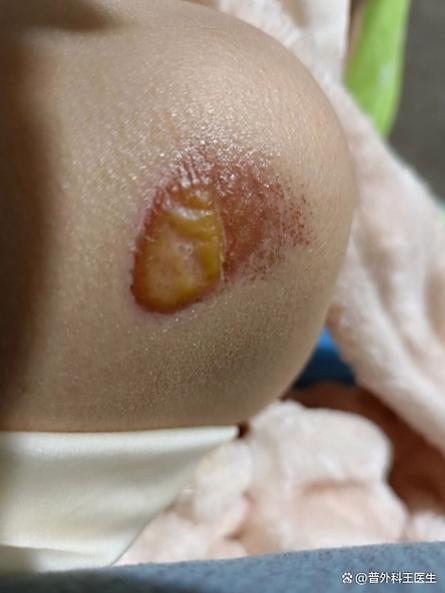 结痂掉了凸起来的疤痕怎么办截图1