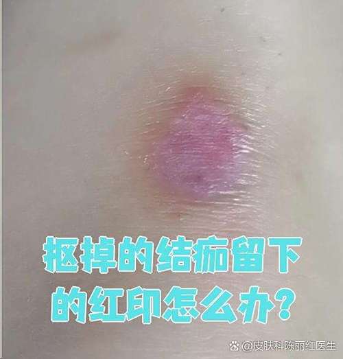 结痂掉了凸起来的疤痕怎么办截图2