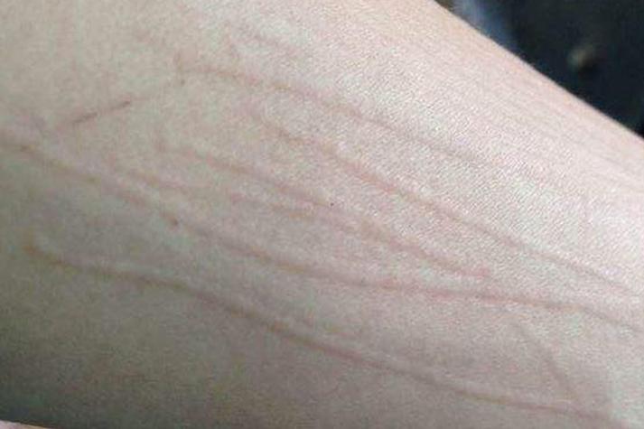 皮肤出现划痕