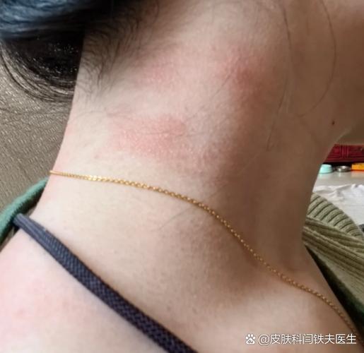 脖子一圈发红痒要警惕