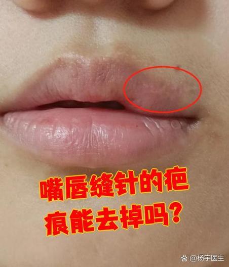 嘴唇缝了针多久能恢复疤痕