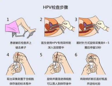 hpv核酸检测怎么检查