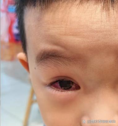 小孩眼睛右眼流眼水 小孩眼睛右眼流眼水