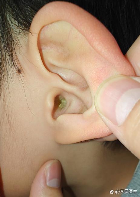耳朵声音闷像隔了一层